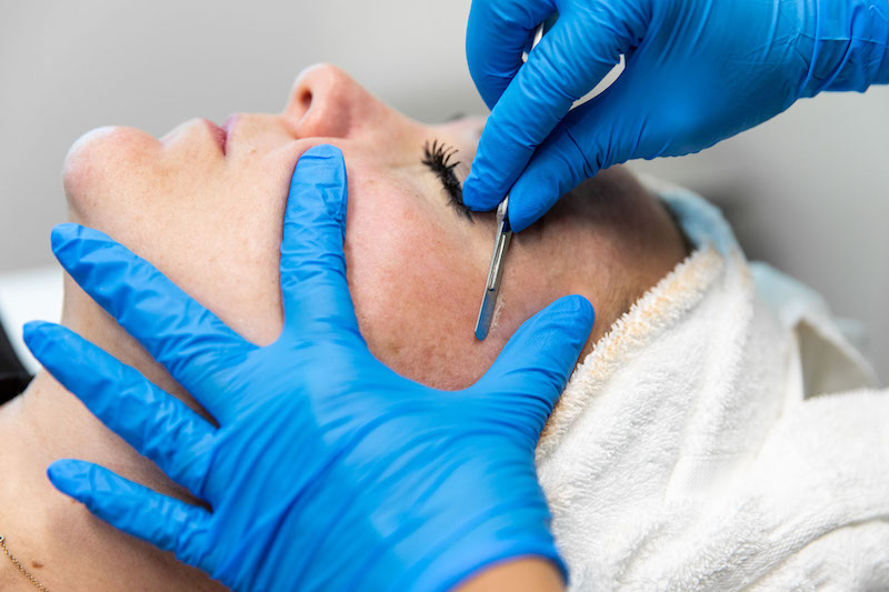 A shot of gloved hands on a patients face as they undergo dermaplaning in Lakewood Ranch