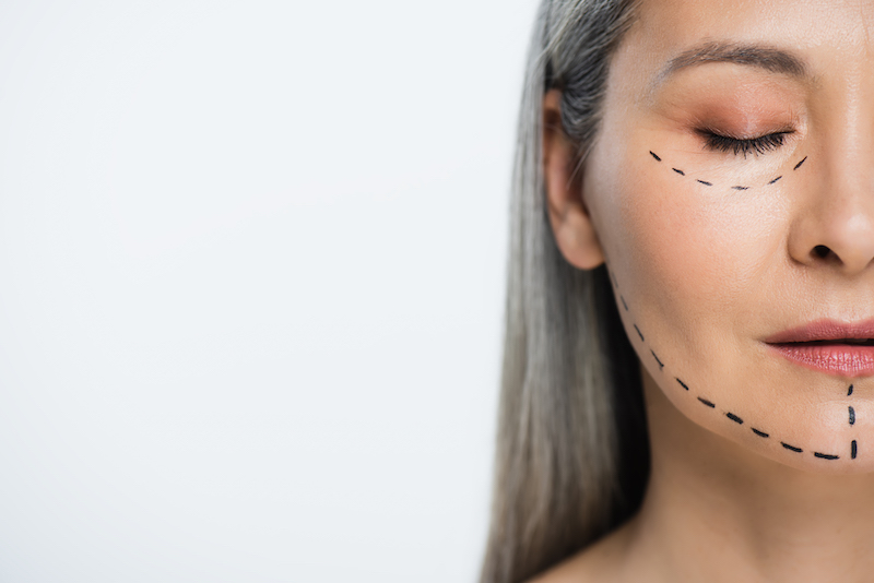 half view of face of asian woman with lines for Dermal Filler in Sarasota