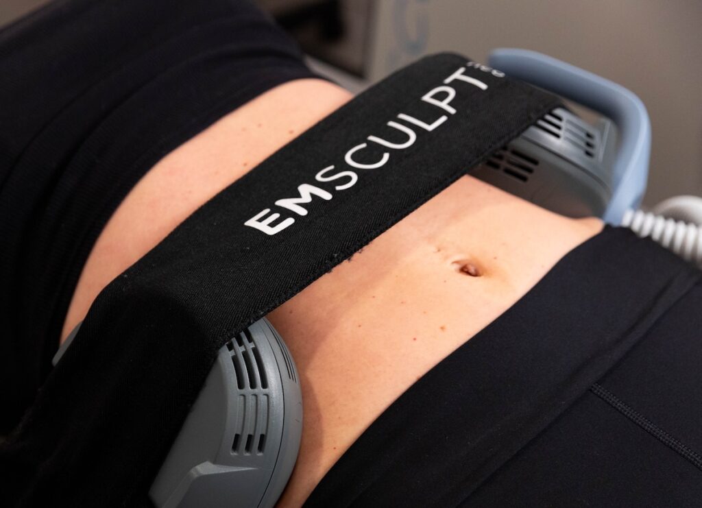 A close-up of a patient's abdomen with 2 Emsculpt NEO paddles on her flanks.